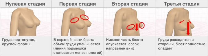 【Вікові зміни форми грудей】 Починаючи з 20 років бюст поступово опускається, у деяких жінок друга стадія починається вже на третьому десятку